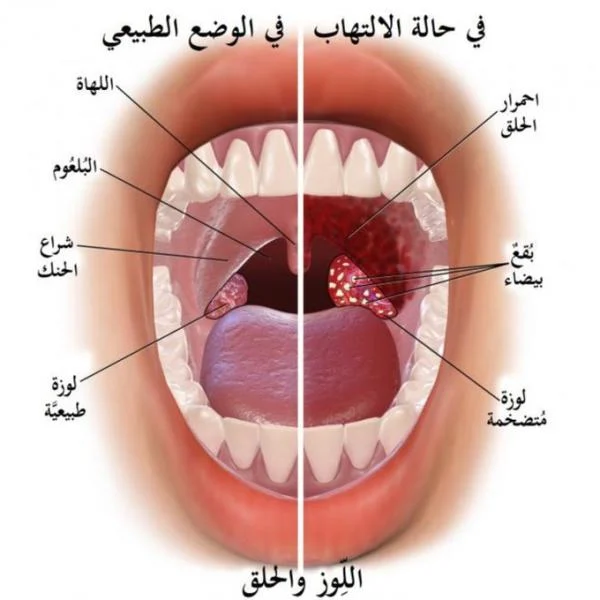 المضاد