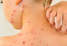 الجدري المائي