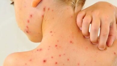 الجدري المائي