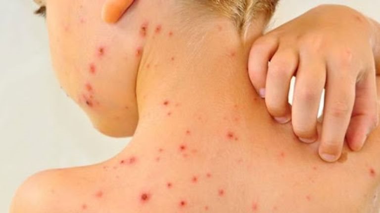 الجدري المائي