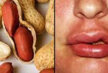 حساسية مكسرات
