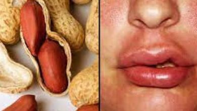 حساسية مكسرات