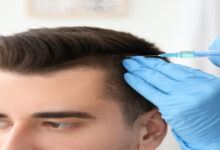 زراعة الشعر