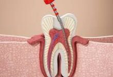 ألم الأسنان