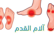 لآلام القدم