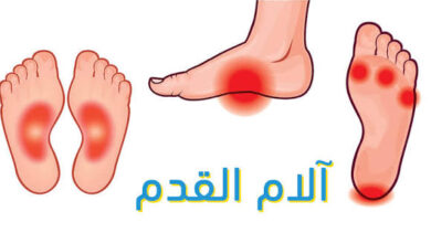 لآلام القدم