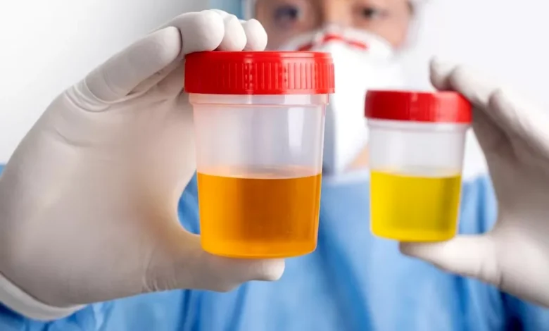 البول الرغوي